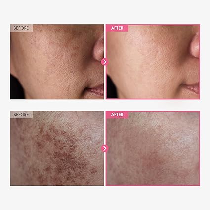 TOSOWOONG Alpha Arbutin & TXA Cream